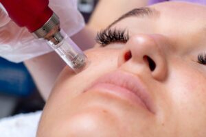 Microneedling 100% digital